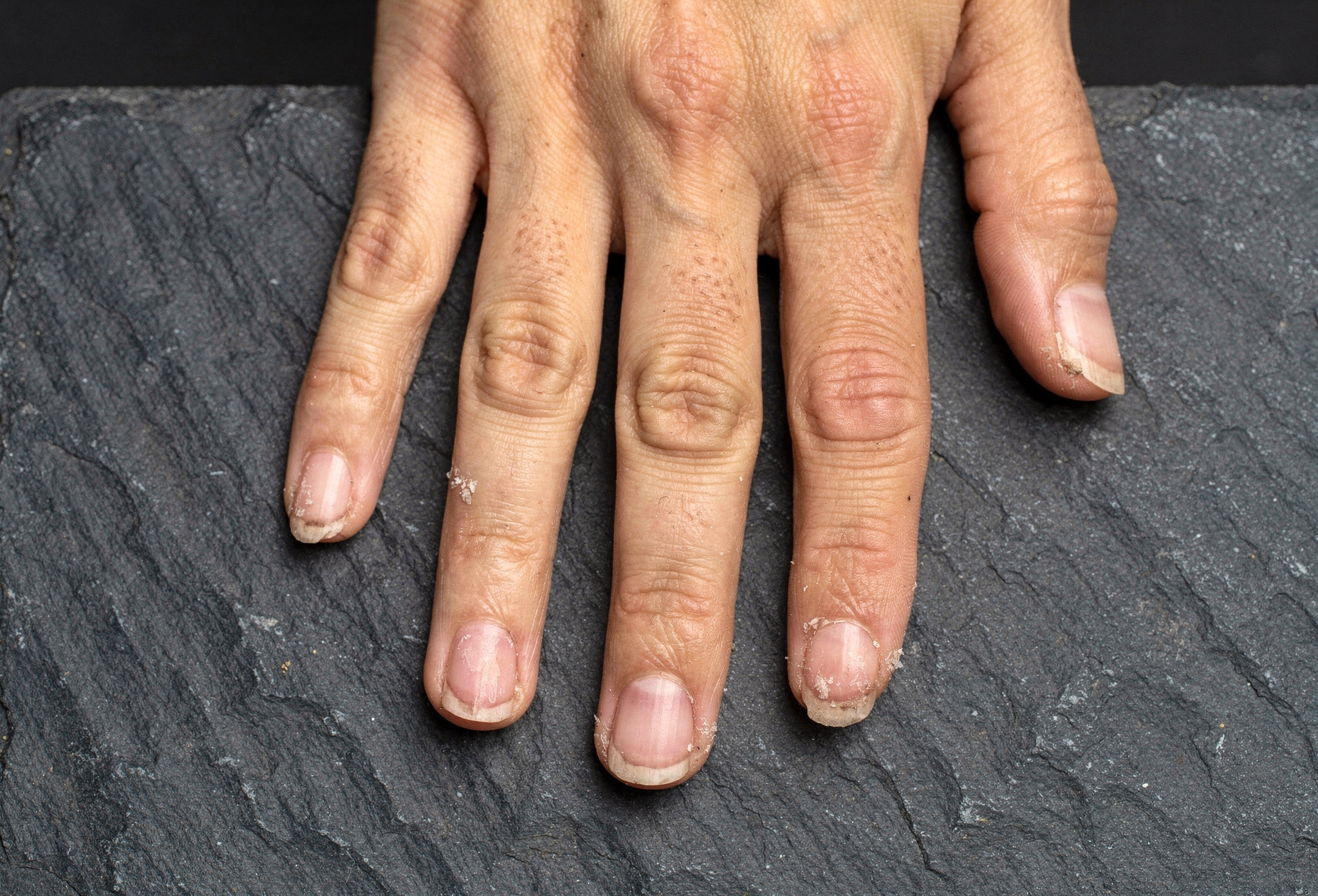 Bakımsız doğal tırnaklar tedavi öncesi durumda koyu arduvaz yüzeyde belgesel çekim